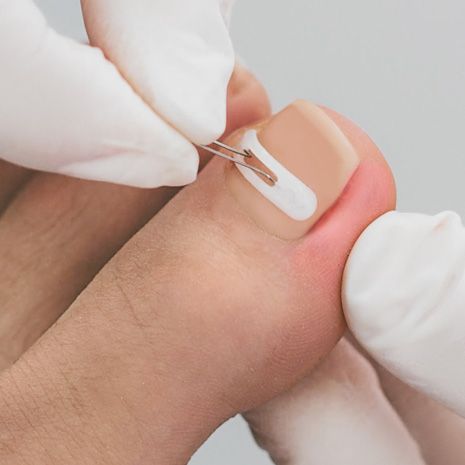 Aufbringen der Podofix Nagelspange