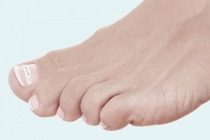 Nagelkorrektur mit Podofix