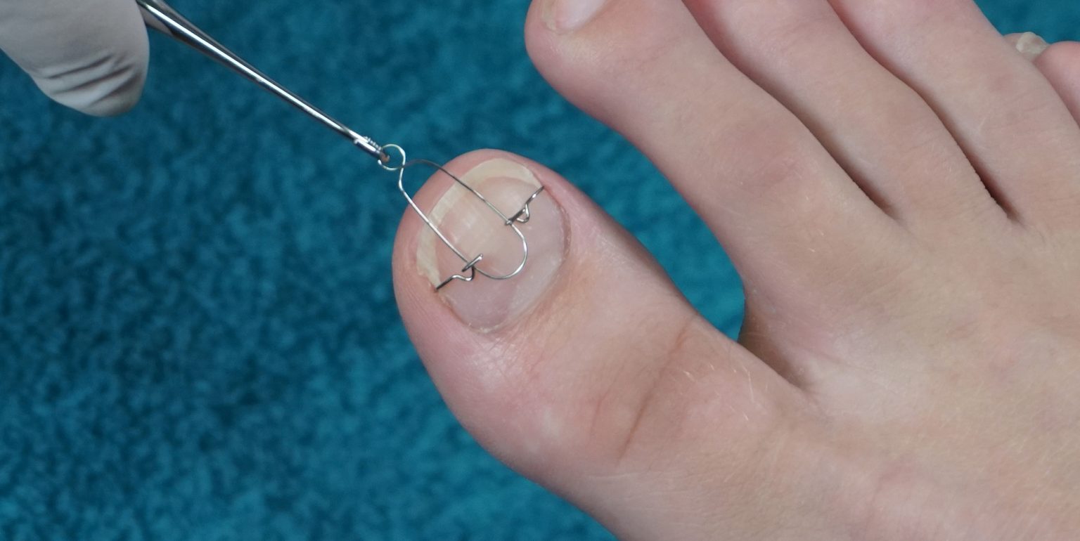 Treatment of ingrown toenails with the 3TO brace 3TO Ihr Spezialist